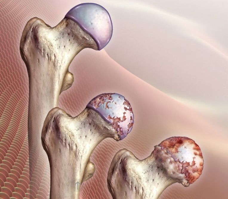 Artrose da articulação do quadril