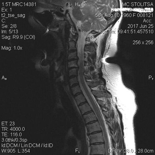 Osteocondrose e espondilose da coluna cervical