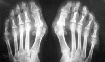 Diagnóstico diferencial de sintomas de artrite e artrose