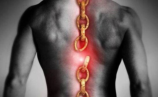 Osteocondrose da região torácica